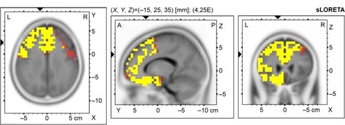 Figure 1 Voxel-wise statistical nonparametric map of sLORETA images in all patients (N=20) compared to healthy controls at the 0.05 significance level after correction for multiple comparisons.