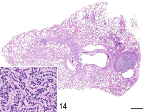 Figure 14. Case 3. Pulmonary adenomas. The lung parenchyma is expanded by variably sized well-demarcated epithelial neoplasms that compress the surrounding alveolar spaces. Inset: The neoplasms consist of clear cuboidal cells with defined margins and a single polarized nucleus. Cellular atypia is minimal. Bar = 1 mm.