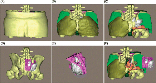 Figure 11. Preoperative surgical planning for patient 1. (A) The entire 3D model. (B) and (C) The 3D model with the skin, subcutaneous fat and gluteus maximus removed, respectively, along the surgical approach. (D) Preoperative osteotomy simulation with 2-mm safety margins from the tumor edges. (E) The resected tumor (in white) and osteotomized bone fragments from the sacrum and ilium. (F) The tumor and bone fragments are moved laterally to check the peritumoral structures again. The osteotomy simulation enables the surgeons to accurately define the osteotomy margins and safely resect the tumor at the time of surgery.