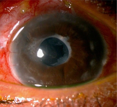 Figure 1 Post-operative tube position in uveitic glaucoma patient.