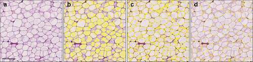 Figure 2. Comparison of alternate pixel classifiers in illustrative cases of poor quality (H&E) histological samples. For size measurement, rendering the seemingly empty adipocyte area correctly is crucial and spillover of staining results in difficulties of the QuPath’s pixel classifier to appropriately detect the cell area (b-d). Training the classifier to recognize weakly stained spillover may help, but sometimes it results in inclusion of weakly stained sections of cell membranes, resulting in detection of falsely conjoined cells (c), or even reversal of detections (d). Scale bar 200 µm.