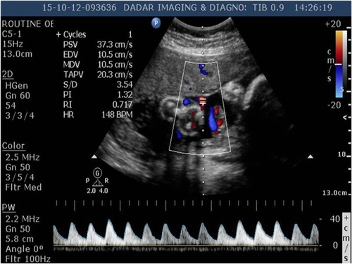 Figure 1 Doppler of umbilical artery showing an increase in systolic/diastolic ratio (3.54) at the time of diagnosis of intrauterine growth restriction and starting sildenafil citrate.