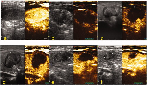 Figure 3. Two-dimensional and CEUS images of thyroid nodules before and after MWA treatment. (a) Before treatment, nodules were oval hypoechoic with well-defined boundaries, and the CEUS showed uniform and high enhancement. (b) Immediately after the operation, nodules were covered by the gasification area, and CEUS showed no enhancement inside nodules. (c–f) The results showed that the volume of the treated area decreased gradually and the VRR increased gradually at 1, 3, 6, and 12 months after the procedure, with the results being 8.7, 44.5, 68.0, and 90.2%, respectively.