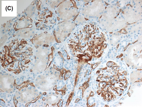 Figure 1c. Immunohistochemical staining for C4d (dilution 1:40, polyclonal Abcam, Cambridge, UK) showed diffuse and strong linear staining in the peritubular capillaries.