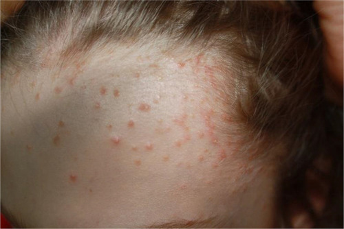Figure 3 Clobetasol propionate shampoo-induced acne in a 14-year-old girl with scalp psoriasis.