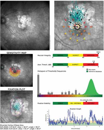 Figure 1. Microperimetry results report of an initial MAIA assessment. The top-left image shows SLO of the fundus, and the top-right image shows combined SLO with SAP. The retinal sensitivity is color co-ordinated and measured in dB and the TRL is identified in blue as the Fixation Training Target (FTT). The bottom-left image identifies the 63% BCEA shown as the smaller purple ring and the larger purple ring represents 95% BCEA. Fixation stability P1 and P2 values are identified in along a normative colored scale.