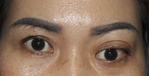 Figure 1 Inferior globe displacement, proptosis and eyelid swelling in the left eye.