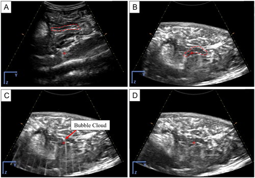 Figure 4. Histotripsy Treatment - Specialty Diet Acute Pigs. Freehand US imaging of pancreas before histotripsy indicated by dashed lines (A). US image with standoff prior to treatment and ROI identified by dashed lines (B). US image during treatment of bubble cloud generated in the pancreas (C) and post-treatment (D). Supplementary Video S1.
