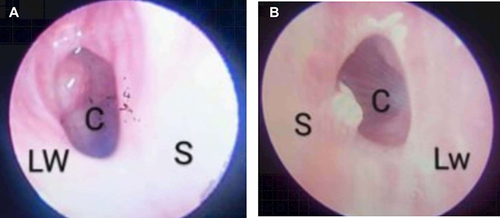 Figure 4 One-month postoperative endoscopic image of the choana (A) Right nasal passage (B) Left nasal passage S: Septum; LW: lateral wall; choanal.