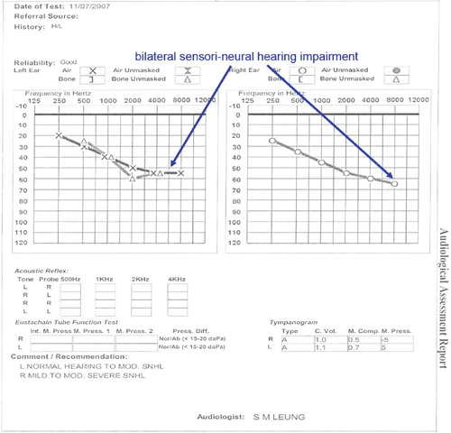 Figure 3. Audiogram of Patient 1 showing bilateral sensori-neural hearing loss.
