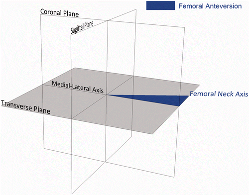 Figure 5. Anatomical femoral version, defined as the angle between the medial-lateral axis and the femoral neck axis measured in the transverse plane.