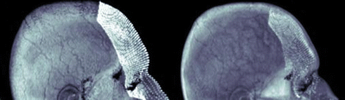 Figure 1. Semi-automatic localization of the outer and the inner surfaces of the thin soft tissue volume. The outer grid is depicted over the face (left). The inner grid is depicted over the skull with transperancy (right).