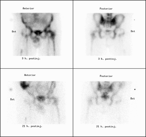 Figure 1. Normal white blood cell scintigraphy. Anterior and posterior images of the hips in a patient with an 8-month-old right-sided total hip prosthesis. The figure shows a normal distribution of 99mTc-HMPAO leukocytes in the hip region. Note there is concordance in the distribution of leukocytes around the femoral component in the right hip in the images obtained 3 h and 21 h after the injection.