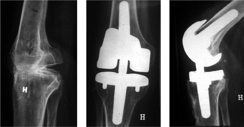 Figure 1. Radiographs before and after conversion of knee arthrodesis to arthroplasty (patient no. 2).
