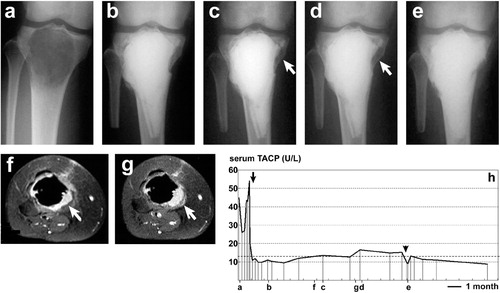 Figure 2. Changes in serum TACP level (panel h) and radiographic images (panels a to g) from one of the GCT patients with local recurrence (a 16-year-old woman). Radiographs of the right tibia with anteroposterior view (a to e) and axial magnetic resonance images of gadolinium-enhanced with fat saturation (TR 400/TE 13) (f, g) were obtained during the pre- and postoperative course. The lower-case letters corresponding to panels a–g represent the time course of examinations shown in the x-axis of the graph (panel h). A continuous decline in TACP level was observed after the first curettage followed by grafting of autologous bone and tricalcium phosphate (black arrow). Re-elevated TACP level accompanying local recurrence was observed and confirmed by radiological imaging (white arrows in panels f, c, g and d). Re-operation with curettage and tricalcium phosphate graft resulted in a reduction of the level to within normal range (black arrow-head).