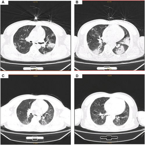 Figure 3 Computed tomography scan results of the patient’s father’s lung. (A, B) On January 25, 2020, multiple exudates and consolidation foci were found in both lungs of the patient’s father, 41-year-old male. Ground glass appearance with distribution under the chest was observed; (C, D) Computed tomography scan images on February 21, 2020 revealed an improvement in the abnormalities.