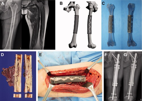 Figure 3. Femoral reconstruction. Images of patient #9. (A) Preoperative plain radiographs and a T2-weighted MR image showing metastatic renal cell carcinoma arising from the femoral shaft. (B) Graphical designs and (C) photograph of the 3D-printed implant. (D) Resected bone tumor as planned. (E) Intraoperative photograph and (F) postoperative plain radiograph showing femoral reconstruction. (G) Follow-up plain radiograph at 3 months postoperatively showing callus formation at both proximal and distal junctions.