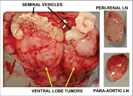 Figure 1 Tramp prostate tumors and metastasis. (A) Large prostate ventral lobe tumors; normal seminal vesicles. (B) Metastatic lesions in lymph nodes (LN).