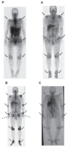 Figure 1 Gallium-67 scintigraphic findings of patients with polymyalgia rheumatica (P), pseudogout A), remitting seronegative symmetrical synovitis with pitting edema (RS3PE) syndrome B), and post-infectious polyarthritis C). A–C corresponds to case A–C in Table 1, respectively. Arrows indicate a gallium uptake. Dotted arrows indicate a gallium uptake in metacarpophalangeal joints in a patient in RS3PE syndrome.