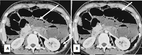 Figure 1 Axial CT-scan: (A) Pneumoperitoneum (white arrows) of large abundance extending to the retroperitoneum, the retrocrural space and the mediastinum; (B) Diffuse hypoenhancement of the small bowel, with marked dilatation (white arrow) of the small and large bowel loops.