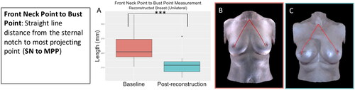 Figure 2. The front neck point to bust point measurement (sternal notch to most projecting point) significantly decreased in the reconstructed breast after unilateral implant-based reconstruction (p < 0.001). (A) Boxplot of the front neck point to bust point measurement at baseline and post-reconstruction (median and interquartile range). (B) The front neck point to bust point measurement on an exemplar patient at baseline. (C) The front neck point to bust point measurement on the same patient post-reconstruction.