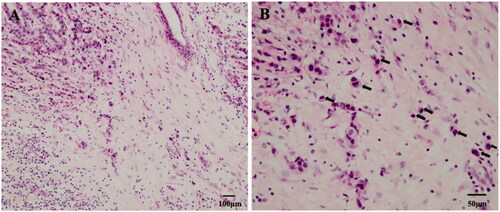 Figure 1. Tumour budding with haematoxylin and eosin (H&E) staining in breast cancer. (a) In the tumour infiltration frontier, we can see a single isolated cancer cell or a cancer nest composed of less than five cancer cells (100×). (b) Tumour buds were observed at 200× using the International Tumour Budding Consensus Conference (ITBCC) recommended method, as shown by the black arrow (200×).