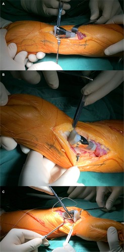 Figure 6 Replacement and repair wrist joint and distal ulnoradial joint.Notes: (A) Implanting was completed. (B) The length of prosthesis was suitable for tumor-induced defect. (C) Repairing the joint with nonabsorbable suture.