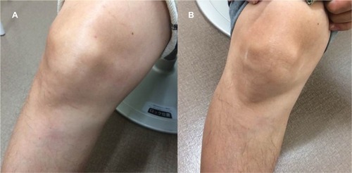 Figure 2 Swelling in the right knee joint (A) and complete healing of the lesion after therapy with ustekinumab (B).