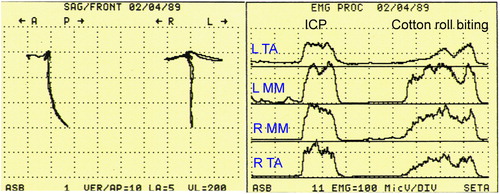 Figure 8. Jaw movements were recorded by the K6 diagnostic system at the 7-year follow-up. Mandibular movements were smooth (left). Bilateral surface EMG recordings were performed using an EM-2. The patient was instructed to clench at ICP and then bite cotton rolls on posterior teeth (right).