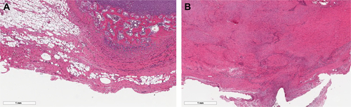 Figure S1 H&E staining of the left Achilles tendon confirmed the pathological findings of tendinopathy and tendon injury models.Note: Five-week-old tendinopathy model showed an irregular pattern of collagen fibers with multiple lipid vacuoles (A), and the 15-week-old tendon injury model showed a thickened irregular pattern of collagen fibers with abundant polymorphic nuclear cells (B).