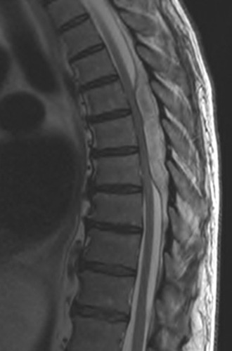 Figure 3 MRI documenting the epidural abscess.