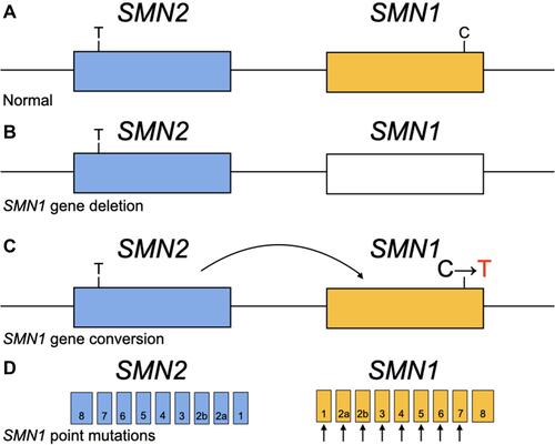 Figure 2 (A) A chromosome carrying a normal copy of SMN1 and SMN2. (B) The blank box indicates a deleted gene. A deletion can remove part or all of the SMN1 gene. (C) The curved arrow represents a conversion. With the C>T transition in SMN1, the SMN1 copy now closely resembles SMN2 and is considered SMN2-like. (D) Point mutations occurring in any of the SMN1 exons prior to the last exon can affect the SMN protein.