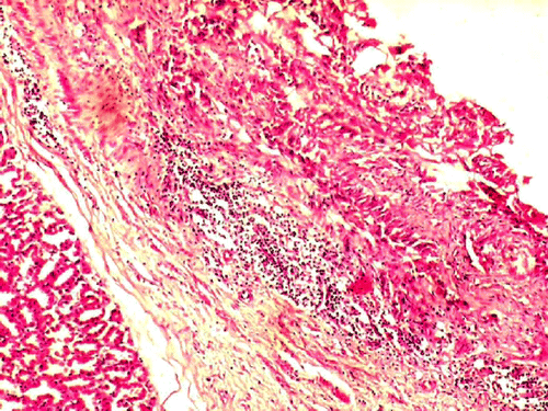 Figure 3.  Group II-proventriculus section showing haemorrhages in the lamina propria accompanied with inflammatory cells (H&E 100X).