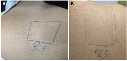 Figure 6 (A) Striae on the back before treatment, (B) improvement of striae after 3 sessions of fractional laser/RF.
