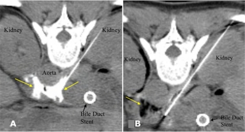 Figure 3 A) CT image after injection of a small volume of dilute contrast agent through both needles, confirming correct distribution of injected contrast around the celiac axis (arrows) prior to alcohol injection. B) After injection of alcohol, darkened region (arrow) shows its distribution in the vicinity of the celiac plexus. Copyright © 2007. Reproduced with permission from Arellano RS. Image-guided pain management, Part 1: celiac plexus block for palliative pain relief. Radiology Rounds, Vol 5. Boston, MA: Massachusetts General Hospital; 2007.