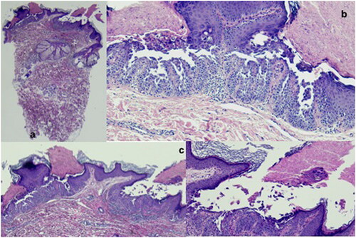 Figure 2. a) Papule of Darier’s disease showing suprabasal acantholysis, with the formation of a small cleft, associated with a thicked stratum corneum, with focal parakeratosis (Haematoxylin-eosin; original magnification 10x); b) Dyskeratotic cells are observed both in the upper malpighian layer and the stratum corneum (corps ronds and grains), floating also in the suprabasal cleft (Haematoxylin-eosin; original magnification 100x); c) Papillary dermis projections covered by a single layer of basal cells extend into the suprabasal cleft. In the superficial dermis is observed mild lymphocytic infiltrate, with rare eosinophils (Haematoxylin-eosin; original magnification 40x).