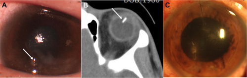 Figure 1 Preoperative photograph, computer tomography, and postoperative photograph of the left eye. (A) Preoperative photography of left eye shows corneal laceration with corneal edema, the traumatic cataract, and tip of an intraocular foreign body (white arrow). (B) Computer tomography image shows the intraocular foreign body (white arrow) that penetrates into the vitreous via the lens. (C) Postoperative photography on day 3 after the operation shows improved corneal edema.