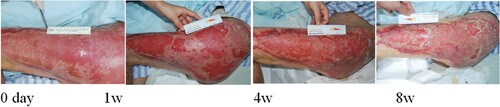 Figure 4. Wang Guiqin, female, 53 years old, suffered from residual burn wounds on her left lower extremity. Her wound was recurrent and uncured for more than 2 months. The healing rate was 87% after 8 weeks of ADSC treatment.