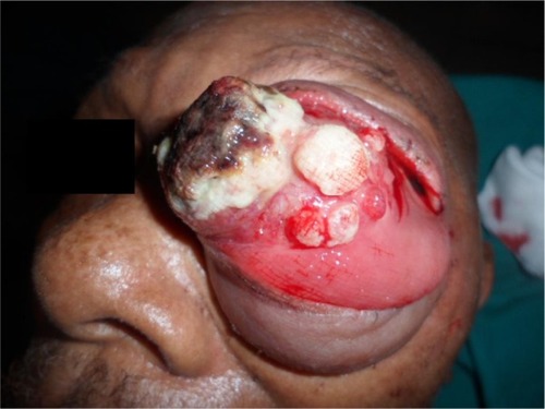 Figure 1 Protrusion of orbital contents.