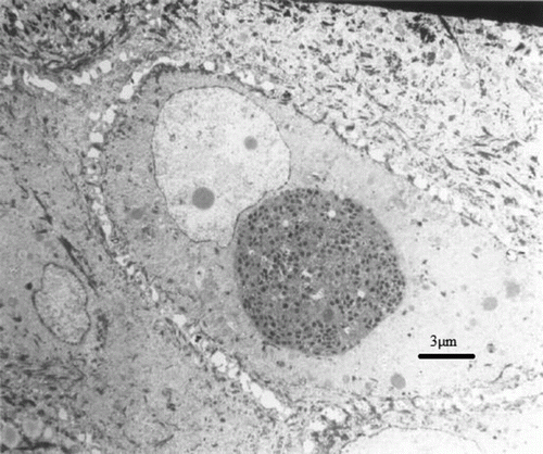 Figure 3.  Intracytoplasmic viral inclusion within an epidermal cell. The inclusion consists of mature virions as well as filaments. Transmission electron microscopy, uranyl acetate–lead citrate.