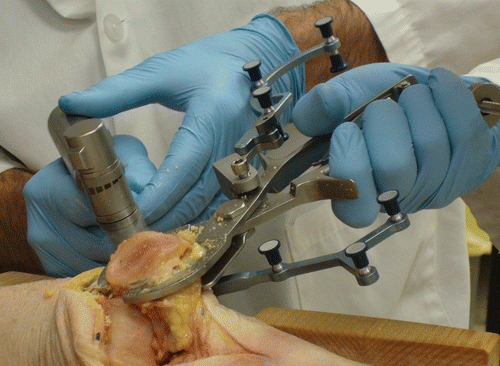 Figure 1. Resecting the patella with an oscillating saw after setting the orientation and placement of the computer-assisted sawguide. Note the “G” marker array mounted on the sawguide and the “Y” marker array mounted on the patella.