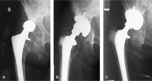 Figure 3. Failure of graft incorporation. A) Preoperative view of right hip of a 75-year-old woman with evidence of lysis around a Ring (Zimmer, Warsaw, IN) polyethylene cementless acetabular component. B) Immediate postoperative view following reconstruction of the acetabulum with a PFC cup (DePuy) autograft and Surgibone (Unilab). C) 18 months after surgery. Extensive migration of the acetabular component, with obliteration of the graft. No evidence of infection.
