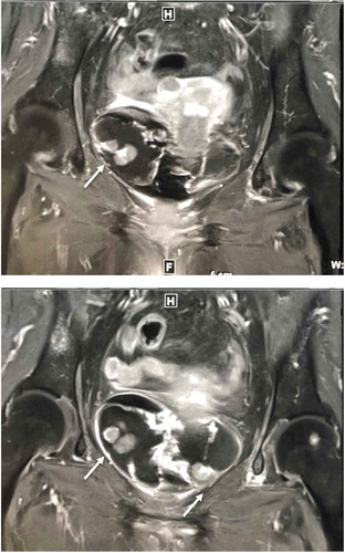 Figure 1. Pelvic MRI:several enhancing solid masses protruding into the bladder lumen were detected in T1-weighted image (arrows)