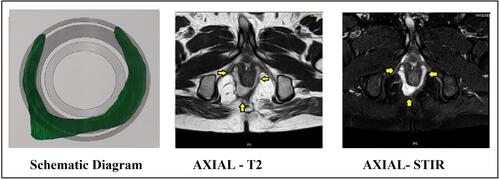 Figure 7 Horseshoe abscess with major component in outer-sphincteric space from 2 to 10 o’clock. (external sphincter muscle cannot be seen lateral to the abscess and the abscess is juxtaposed to the fat in ischiorectal fossa). Abscess indicated by yellow arrows. Left panel: schematic diagram. Middle panel: MRI axial section T-2 sequence. Right panel: MRI axial section STIR sequence.