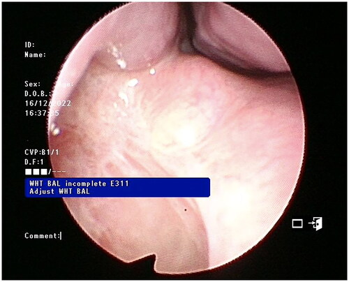 Figure 3. Endoscopic view of the left nasal cavity at 3 months post-surgery showing the wide opening into the well-healed cyst cavity.