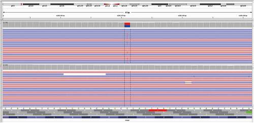 Figure 4. Gene mapping of the patient (performed on 17-05-2018). A missense mutation (C to T) was identified at nt 305 in one allele of PRNP, which led to a change from proline (Pro) to leucine (Leu) at codon 102.