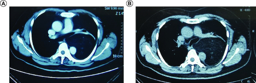 Figure 1. CT images of the tumor.CT picture before first surgery (A) and recurrence CT picture after first surgery (B).