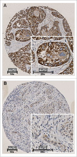 Figure 4. Representative examples of RAB25 expression in 2 OSCC as detected by immunohistochemistry. Tissues were scored by the amount of RAB25-positive cells. (A) Example of a well-differentiated OSCC with a high amount of RAB25-expressing cells. (B) Example of a poorly differentiated OSCC with a very low amount of RAB25-positive cells.