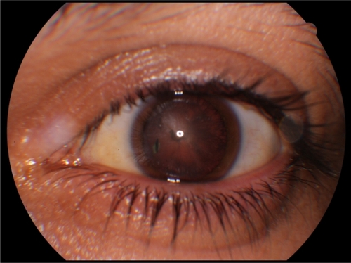 Figure 1 An intralenticular foreign body is seen in the seven o’clock meridian of the lens.