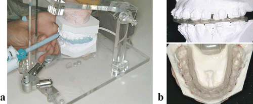 Figure 12. Fabrication of the occlusal splint. (a) Bite registration. (b) Occlusal wafer splint. [Color version available online.]